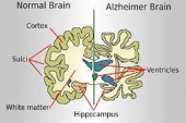 ALZHEIMER’S AFECTS YOUR SENSE OF SMELL